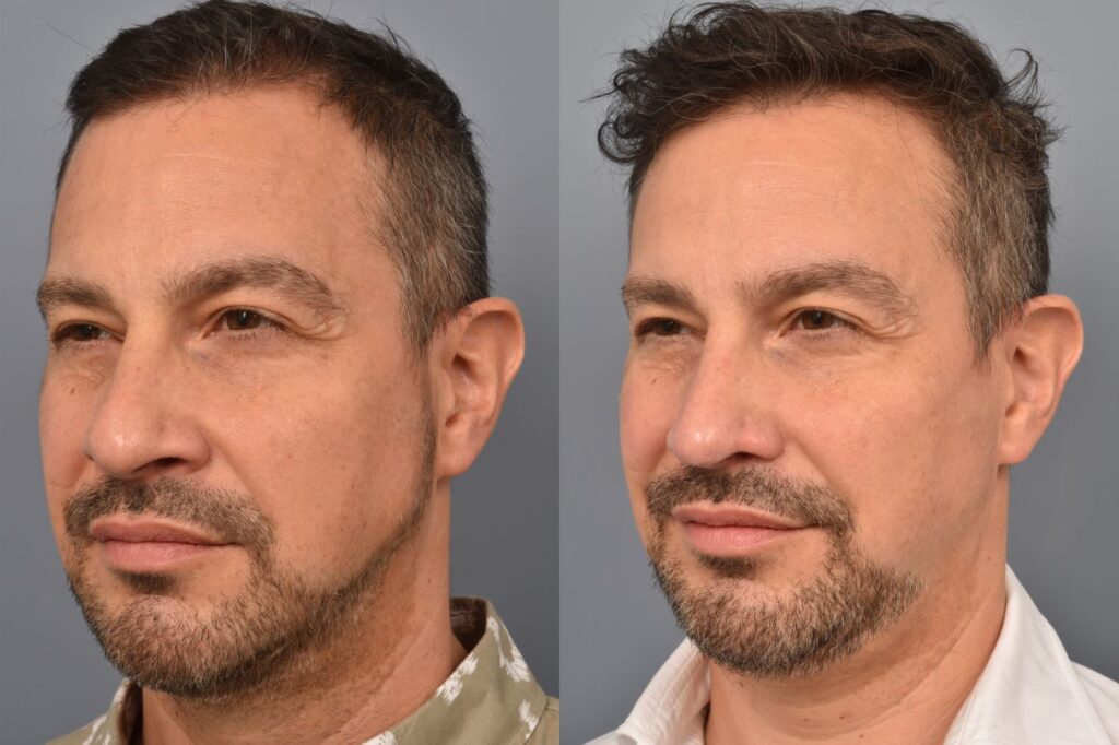 Photo of male before and after revision rhinoplasty
