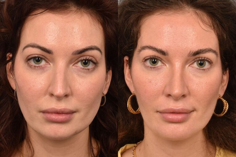 Photo of female before and after buccal fate removal