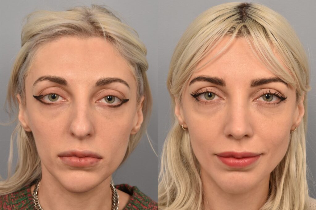 Left side of image is of a female patient's face showing her from a front on view before undergoing a rhinoplasty procedure with Dr. Pearlman. Right side of picture is the same female with the same view except it is after her rhinoplasty procedure. This is a side by side comparison of her rhinoplasty results before and after surgery.