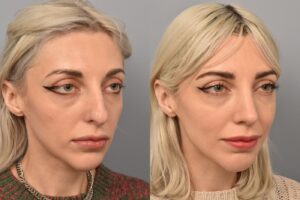 Left side of image is of female patient's face showing her right 3/4 view before undergoing a rhinoplasty procedure with Dr. Pearlman. Right side of picture is the same female and same view except it is after her rhinoplasty procedure. This is a side by side comparison of rhinoplasty results before and after her surgery.