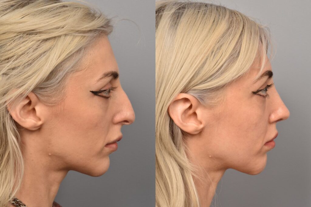 Photo of female before and after rhinoplasty