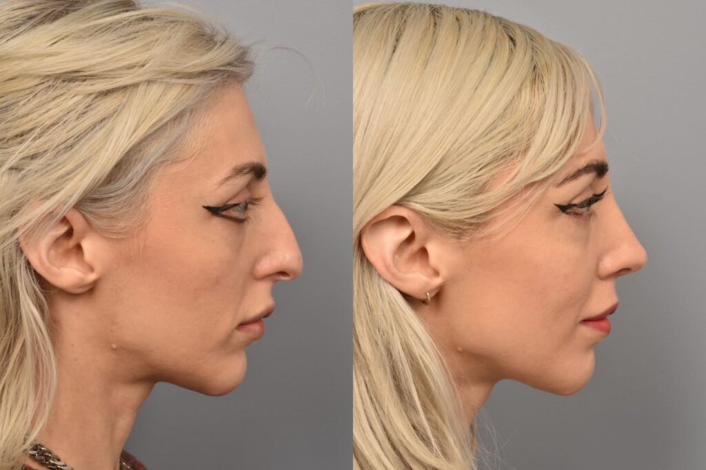 Left side of image is of female patient's face showing her right profile before undergoing a rhinoplasty procedure with Dr. Pearlman. Right side of picture is the same female and same view except it is after her rhinoplasty procedure. This is a side by side comparison of rhinoplasty results before and after her surgery.