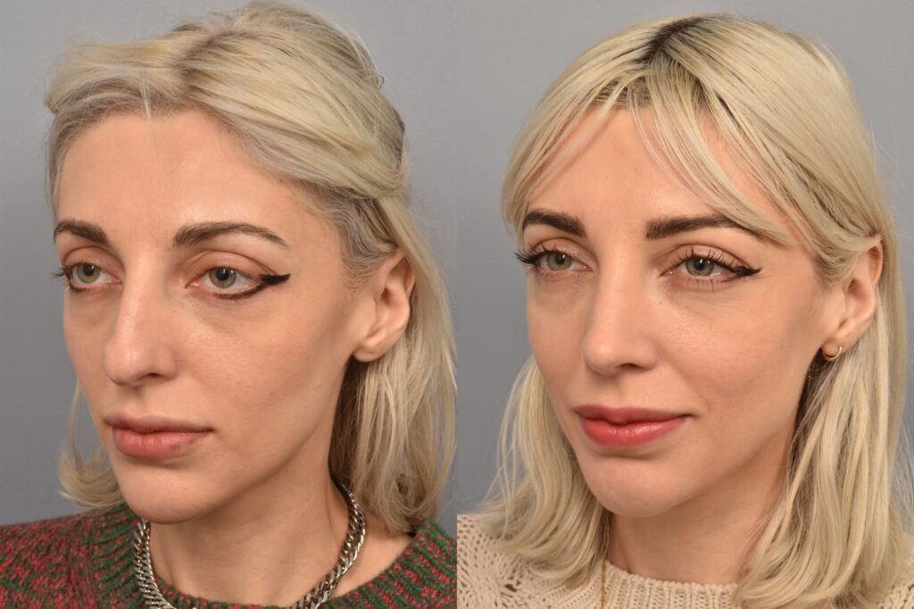 Left side of image is of female patient's face showing her left 3/4 view before undergoing a rhinoplasty procedure with Dr. Pearlman. Right side of picture is the same female and same view except it is after her rhinoplasty procedure. This is a side by side comparison of rhinoplasty results before and after her surgery.