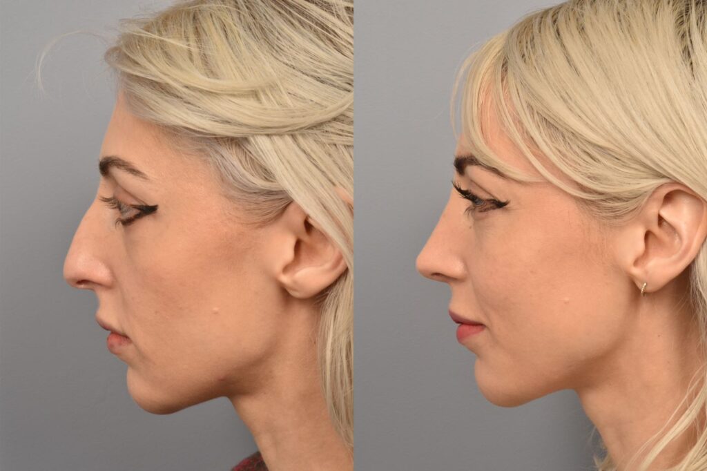 Left side of image is of female patient's face showing her left profile before undergoing a rhinoplasty procedure with Dr. Pearlman. Right side of picture is the same female and same view except it is after her rhinoplasty procedure. This is a side by side comparison of rhinoplasty results before and after her surgery.