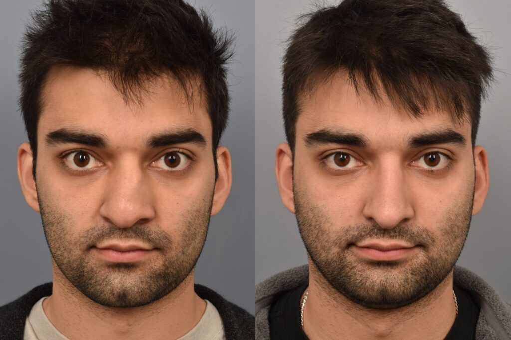 Photo of male before and after rhinoplasty