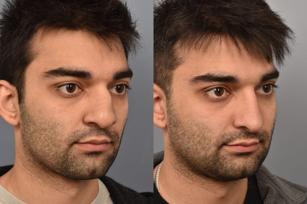 Photo of male before and after rhinoplasty