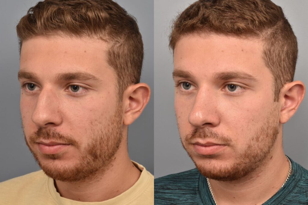 Photo of a male before and after rhinoplasty