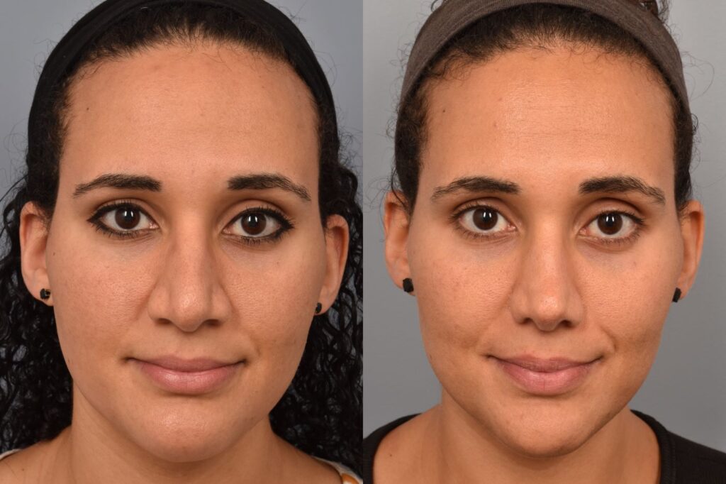 Photo of a male before and after rhinoplasty
