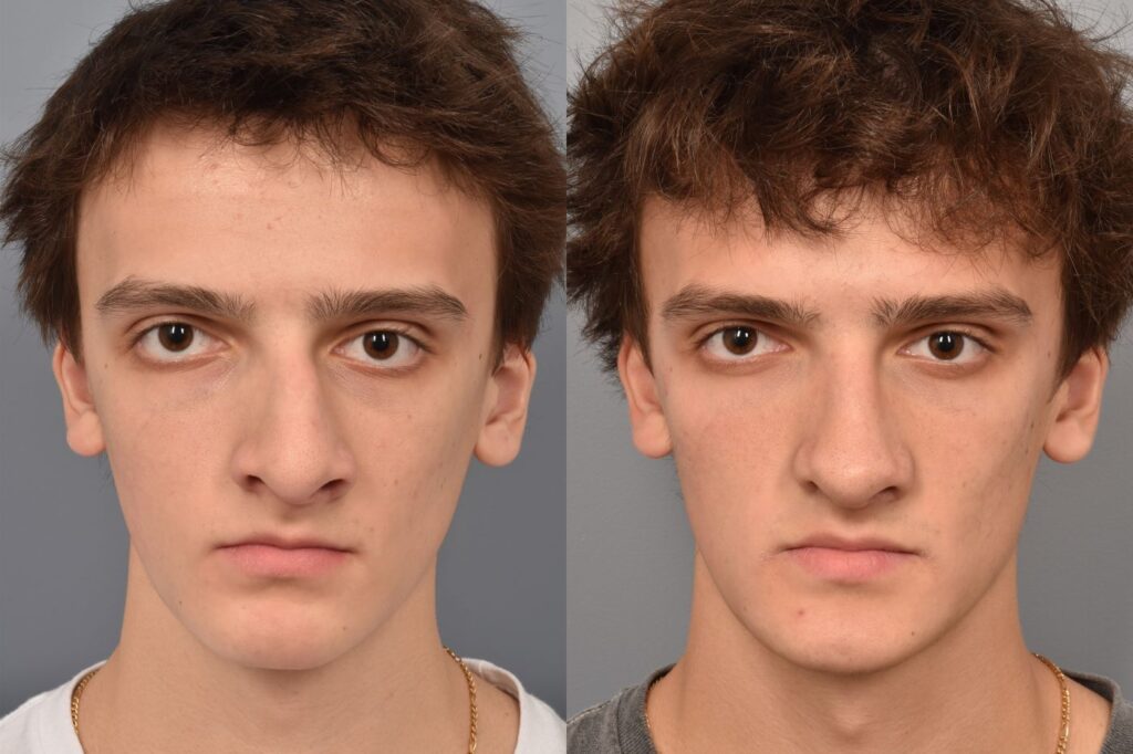Left side of image is of teenage male patient's face showing straight on view before undergoing a rhinoplasty procedure with Dr. Pearlman. Right side of picture is the same male and same view except it is after her rhinoplasty procedure. This is a side by side comparison of rhinoplasty results before and after his surgery.