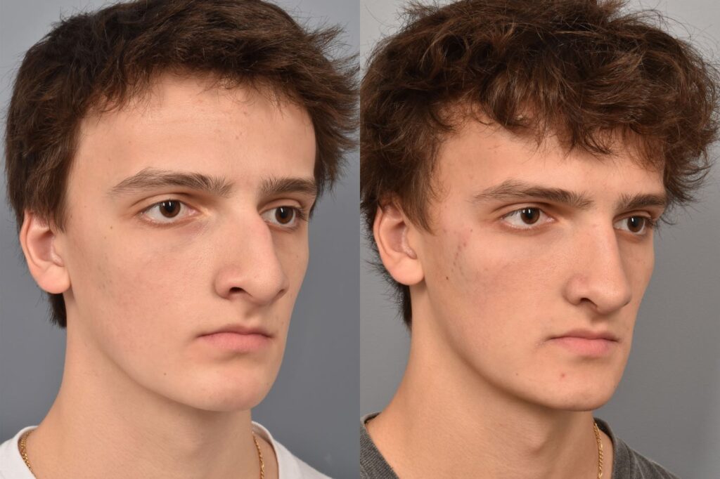 Left side of image is of teenage male patient's face showing his right 3/4 view before undergoing a rhinoplasty procedure with Dr. Pearlman. Right side of picture is the same male and same view except it is after her rhinoplasty procedure. This is a side by side comparison of rhinoplasty results before and after his surgery.