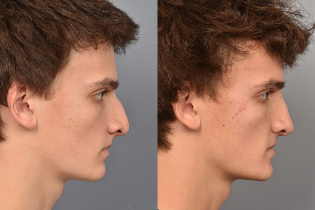 Left side of image is of teenage male patient's face showing his right profile before undergoing a rhinoplasty procedure with Dr. Pearlman. Right side of picture is the same male and same view except it is after her rhinoplasty procedure. This is a side by side comparison of rhinoplasty results before and after his surgery.