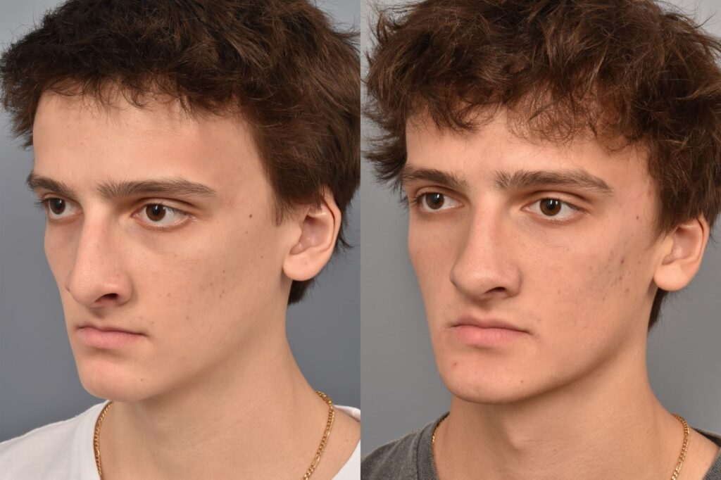 Left side of image is of teenage male patient's face showing his left 3/4 view before undergoing a rhinoplasty procedure with Dr. Pearlman. Right side of picture is the same male and same view except it is after her rhinoplasty procedure. This is a side by side comparison of rhinoplasty results before and after his surgery.