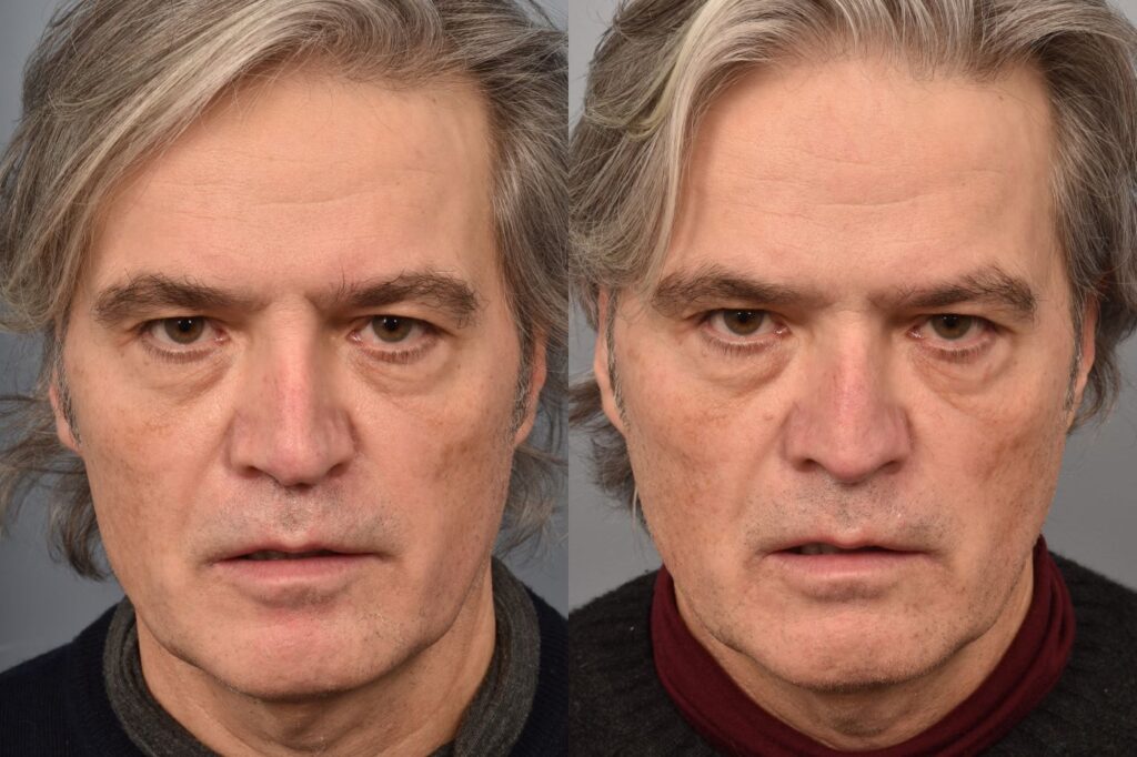 Left side of image is of male patient's face showing his front view before undergoing a revision rhinoplasty procedure with Dr. Pearlman. Right side of picture is the same male and same view except it is after his revision rhinoplasty procedure. This is a side by side comparison of rhinoplasty results before and after his surgery.