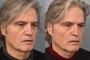 Left side of image is of male patient's face showing his right 3/4 view before undergoing a revision rhinoplasty procedure with Dr. Pearlman. Right side of picture is the same male and same view except it is after his revision rhinoplasty procedure. This is a side by side comparison of rhinoplasty results before and after his surgery.