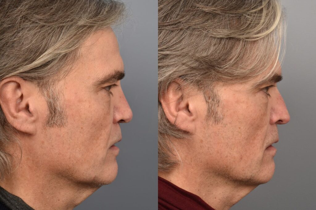 Left side of image is of male patient's face showing his right profile before undergoing a revision rhinoplasty procedure with Dr. Pearlman. Right side of picture is the same male and same view except it is after his revision rhinoplasty procedure. This is a side by side comparison of rhinoplasty results before and after his surgery.