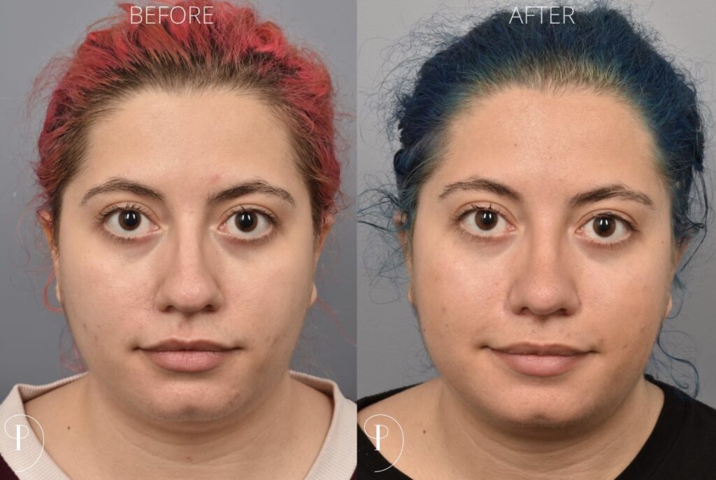 Left side of image is of a female patient's face showing her from a front on view before undergoing a rhinoplasty procedure with Dr. Pearlman. Right side of picture is the same female with the same view except it is after her rhinoplasty procedure. This is a side by side comparison of her rhinoplasty results before and after