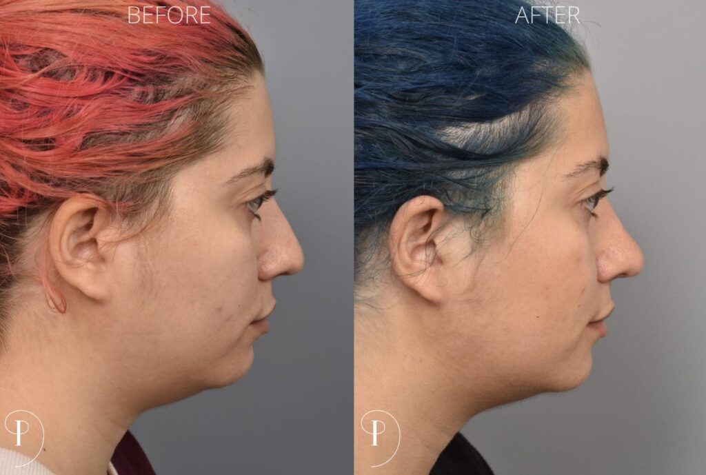 Left side of image is of a female patient's face showing her right profile before undergoing a rhinoplasty procedure with Dr. Pearlman. Right side of picture is the same female with the same view except it is after her rhinoplasty procedure. This is a side by side comparison of her rhinoplasty results before and after