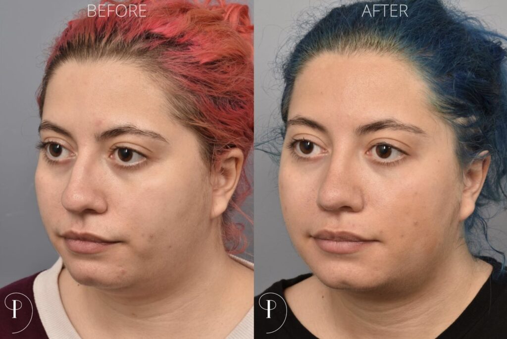 Left side of image is of a female patient's face showing her left 3/4 view before undergoing a rhinoplasty procedure with Dr. Pearlman. Right side of picture is the same female with the same view except it is after her rhinoplasty procedure. This is a side by side comparison of her rhinoplasty results before and after