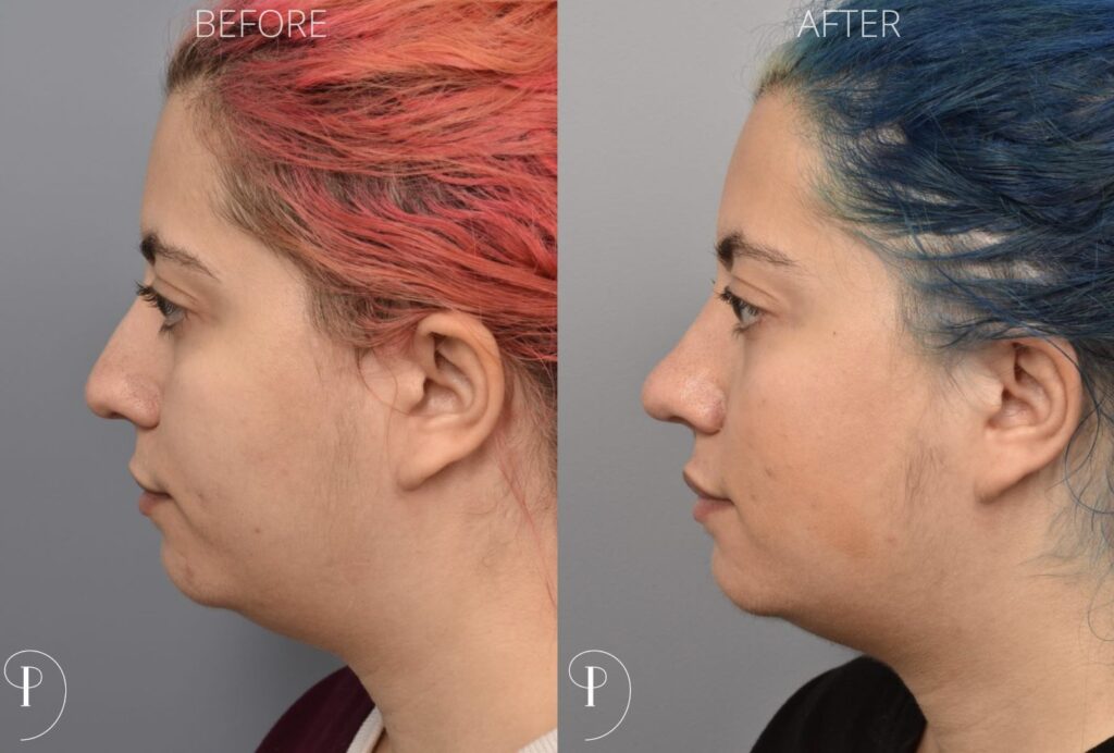 Left side of image is of a female patient's face showing her left profile before undergoing a rhinoplasty procedure with Dr. Pearlman. Right side of picture is the same female with the same view except it is after her rhinoplasty procedure. This is a side by side comparison of her rhinoplasty results before and after