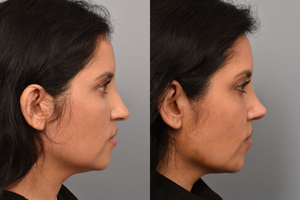 Left side of image is of a female patient's face showing her right profile before undergoing a rhinoplasty procedure with Dr. Pearlman. Right side of picture is the same female with the same view except it is after her rhinoplasty procedure. This is a side by side comparison of her rhinoplasty results before and after
