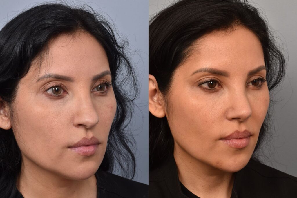 Left side of image is of a female patient's face showing her right 3/4 view before undergoing a rhinoplasty procedure with Dr. Pearlman. Right side of picture is the same female with the same view except it is after her rhinoplasty procedure. This is a side by side comparison of her rhinoplasty results before and after