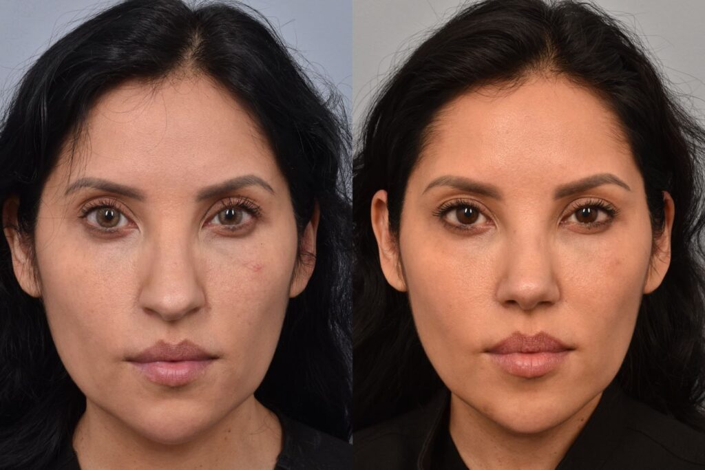 Left side of image is of a female patient's face showing her from a front on view before undergoing a rhinoplasty procedure with Dr. Pearlman. Right side of picture is the same female with the same view except it is after her rhinoplasty procedure. This is a side by side comparison of her rhinoplasty results before and after