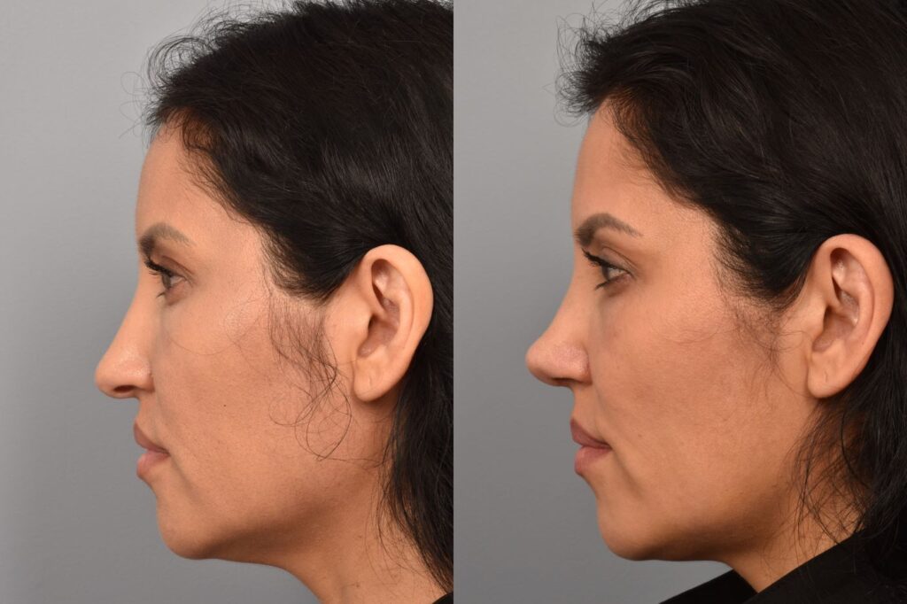Left side of image is of a female patient's face showing her left profile before undergoing a rhinoplasty procedure with Dr. Pearlman. Right side of picture is the same female with the same view except it is after her rhinoplasty procedure. This is a side by side comparison of her rhinoplasty results before and after surgery.