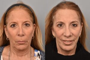 Left side of image is of a female patient's face showing her front on photo before undergoing a facelift procedure with Dr. Pearlman. Right side of picture is the same patient with the same view except it is after their facelift procedure. This is a side by side comparison of facelift results before and after surgery.