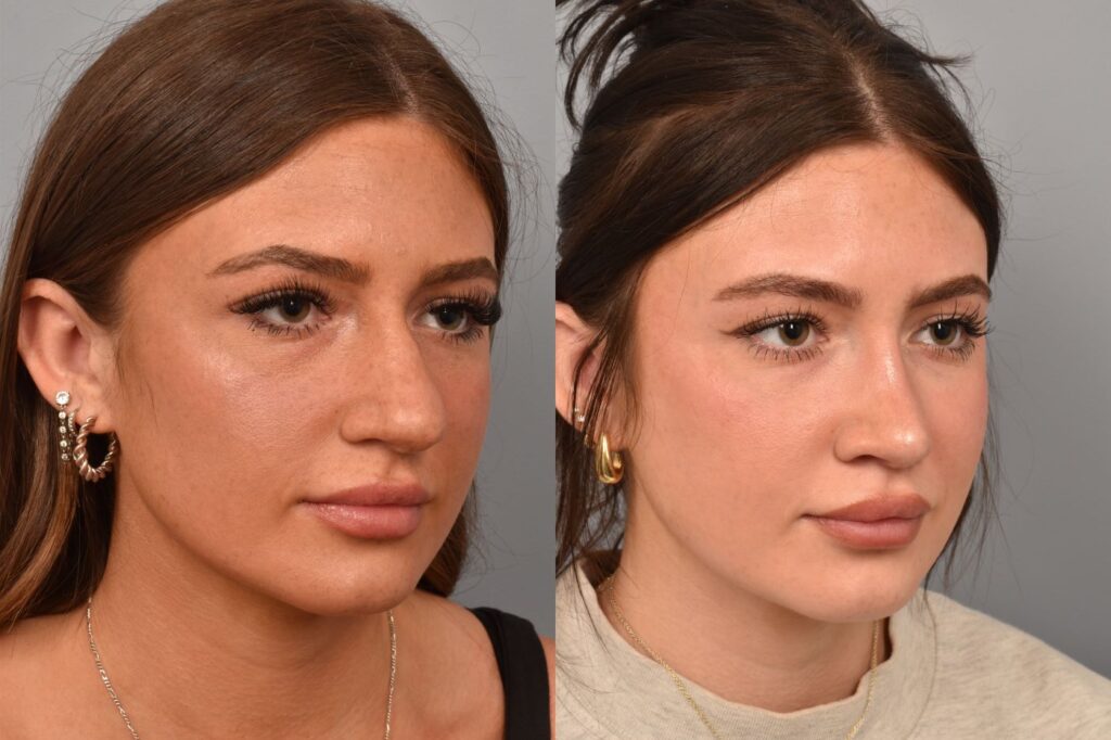 Left side of image is of a female patient's face showing her right 3/4 view before undergoing a rhinoplasty procedure with Dr. Pearlman. Right side of picture is the same female with the same view except it is after her rhinoplasty procedure. This is a side by side comparison of her rhinoplasty results before and after