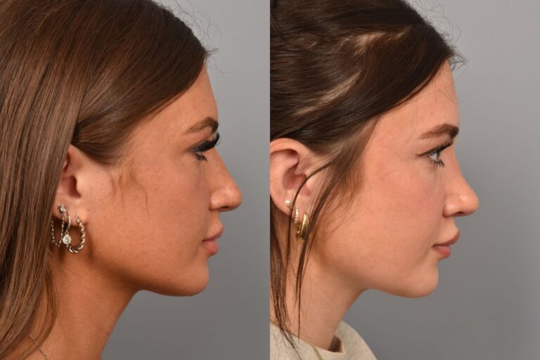 Left side of image is of a female patient's face showing her right profile before undergoing a rhinoplasty procedure with Dr. Pearlman. Right side of picture is the same female with the same view except it is after her rhinoplasty procedure. This is a side by side comparison of her rhinoplasty results before and after