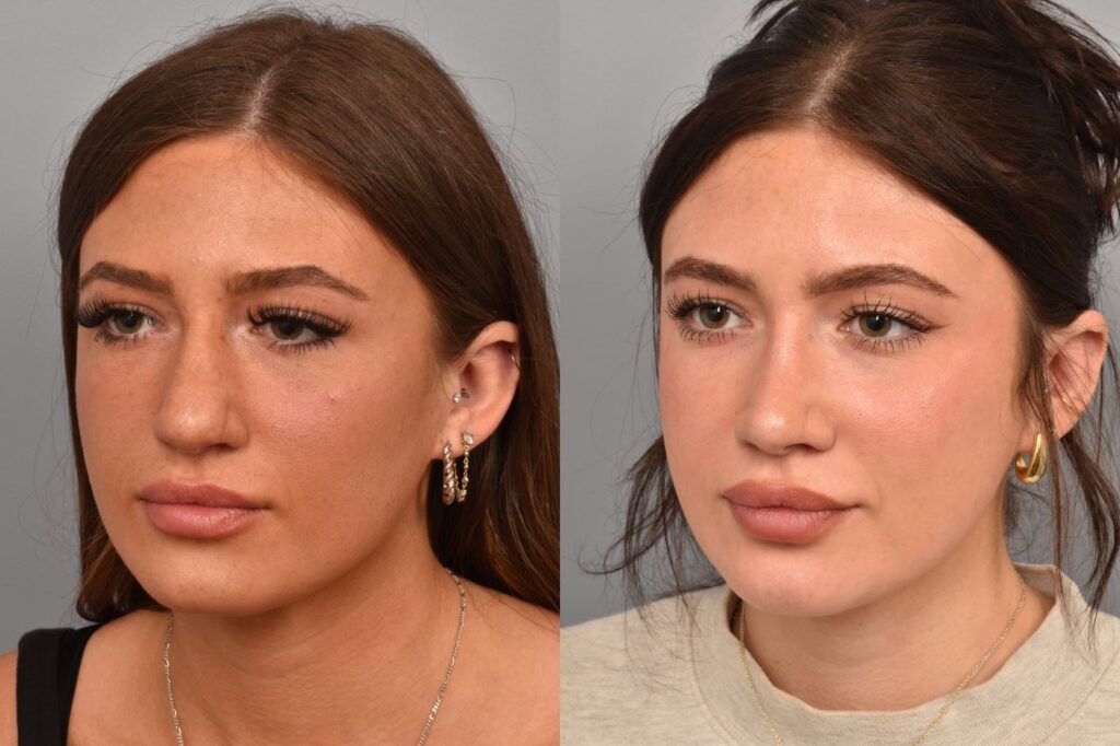 Left side of image is of a female patient's face showing her left 3/4 view before undergoing a rhinoplasty procedure with Dr. Pearlman. Right side of picture is the same female with the same view except it is after her rhinoplasty procedure. This is a side by side comparison of her rhinoplasty results before and after