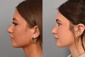 Left side of image is of a female patient's face showing her left profile before undergoing a rhinoplasty procedure with Dr. Pearlman. Right side of picture is the same female with the same view except it is after her rhinoplasty procedure. This is a side by side comparison of her rhinoplasty results before and after surg