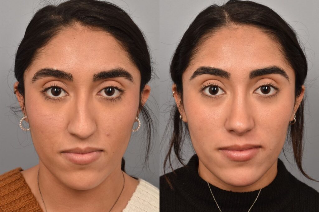 Left side of image is of a female patient's face showing her from a front on view before undergoing a rhinoplasty procedure with Dr. Pearlman. Right side of picture is the same female with the same view except it is after her rhinoplasty procedure. This is a side by side comparison of her rhinoplasty results before and after