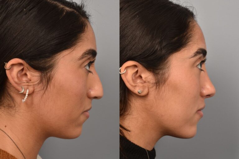 Left side of image is of a female patient's face showing her right profile before undergoing a rhinoplasty procedure with Dr. Pearlman. Right side of picture is the same female with the same view except it is after her rhinoplasty procedure. This is a side by side comparison of her rhinoplasty results before and after