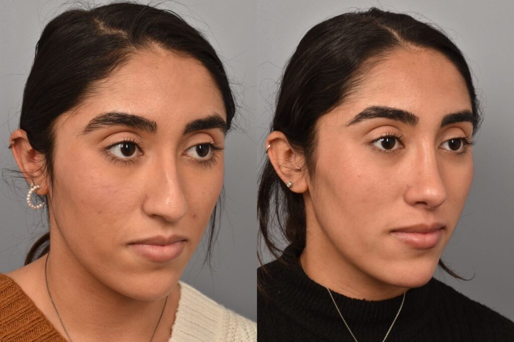 Left side of image is of a female patient's face showing her right 3/4 view before undergoing a rhinoplasty procedure with Dr. Pearlman. Right side of picture is the same female with the same view except it is after her rhinoplasty procedure. This is a side by side comparison of her rhinoplasty results before and after