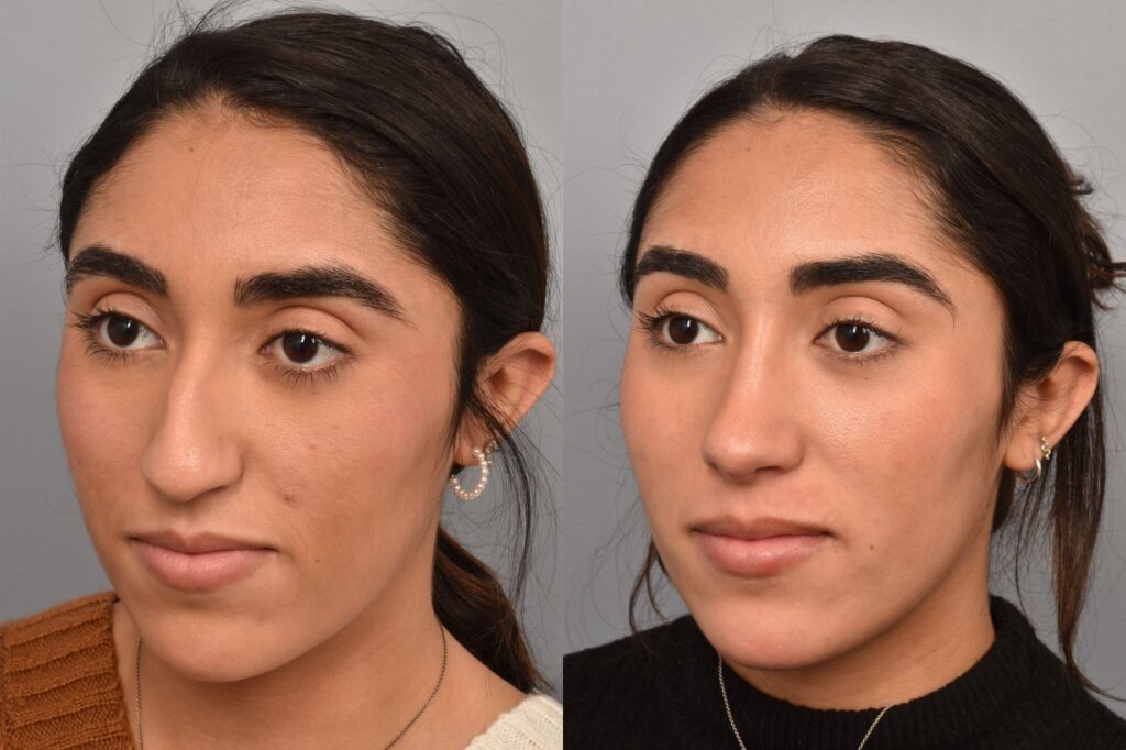 Left side of image is of a female patient's face showing her left 3/4 view before undergoing a rhinoplasty procedure with Dr. Pearlman. Right side of picture is the same female with the same view except it is after her rhinoplasty procedure. This is a side by side comparison of her rhinoplasty results before and after