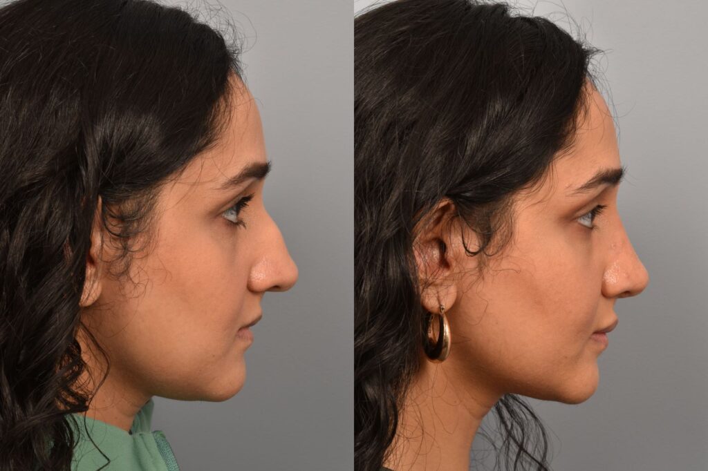 Left side of image is of a female patient's face showing her right profile before undergoing a rhinoplasty procedure with Dr. Pearlman. Right side of picture is the same female with the same view except it is after her rhinoplasty procedure. This is a side by side comparison of her rhinoplasty results before and after