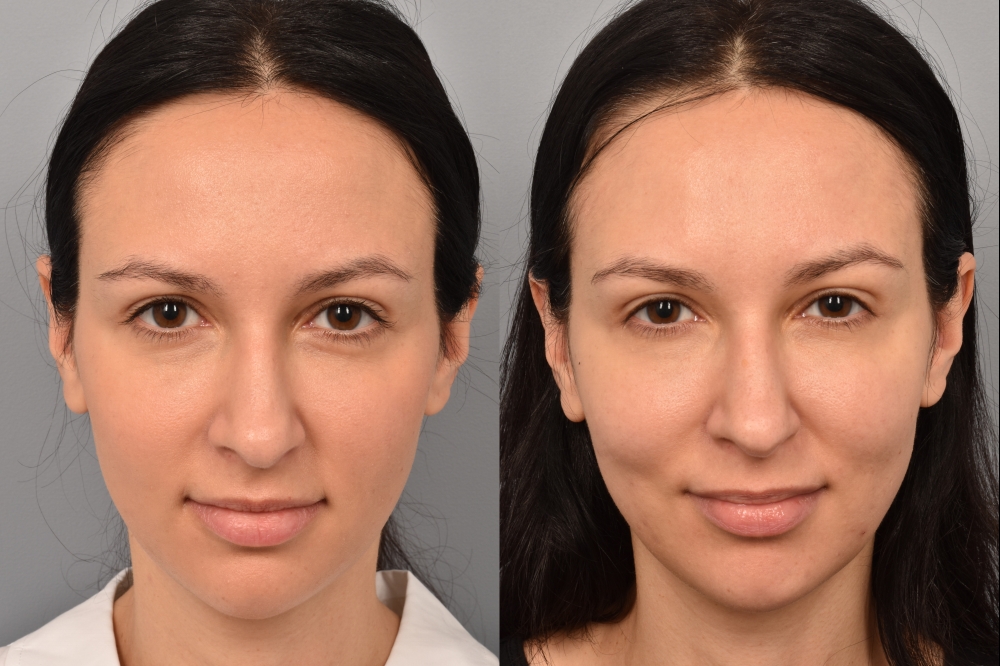 Left side of image is of a female patient's face showing her forward facing before undergoing a necklift procedure with Dr. Pearlman. Right side of picture is the same female with the same view except it is after her necklift procedure. This is a side by side comparison of her facelift results before and after surgery