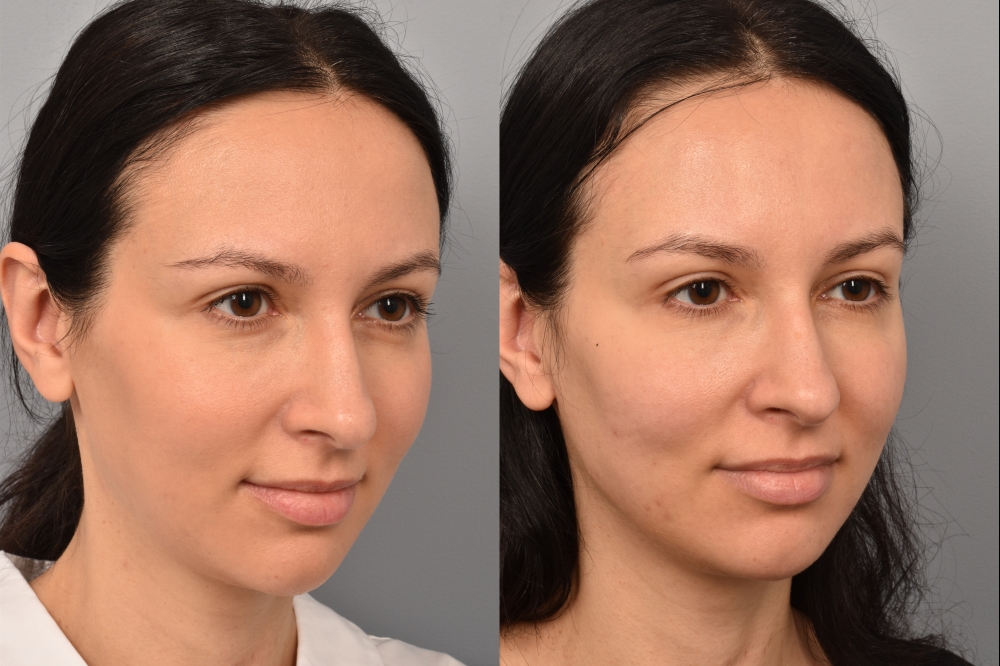 Left side of image is of a female patient's face showing her 3/4 right side view before undergoing a neck lift procedure with Dr. Pearlman. Right side of picture is the same female with the same view except it is after her neck lift procedure. This is a side by side comparison of her facelift results before and after surgery