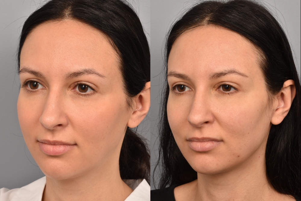 Left side of image is of a female patient's face showing her 3/4 left side view before undergoing a neck lift procedure with Dr. Pearlman. Right side of picture is the same female with the same view except it is after her neck lift procedure. This is a side by side comparison of her facelift results before and after surgery