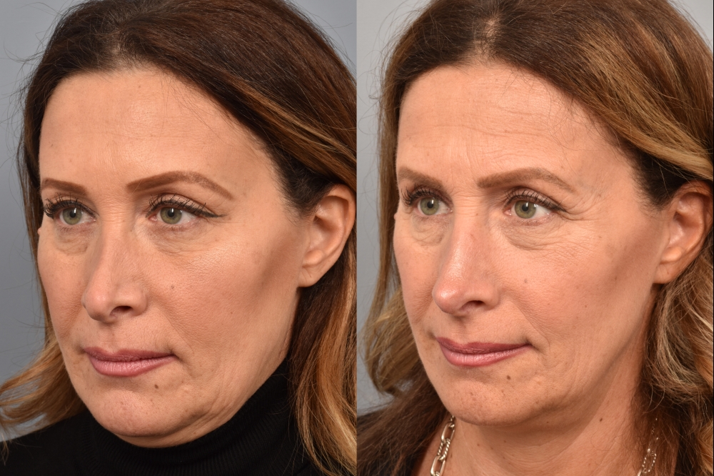 Side-by-side comparison of a female patient's left 3/4 view before and after revision rhinoplasty by Dr. Pearlman. The left image shows her nose prior to surgery; the right image shows the same angle post-procedure