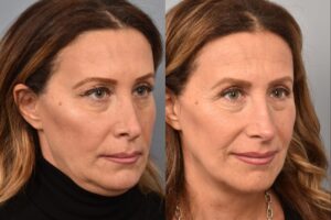Side-by-side comparison of a female patient's right 3/4 view before and after revision rhinoplasty by Dr. Pearlman. The left image shows her nose prior to surgery; the right image shows the same angle post-procedure