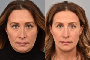 Side-by-side comparison of a female patient's straight-on view before and after revision rhinoplasty by Dr. Pearlman. The left image shows her nose prior to surgery; the right image shows the same angle post-procedure