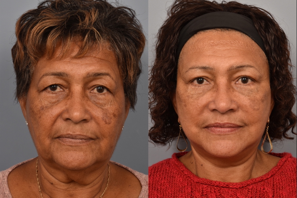 Side-by-side comparison of a female patient's straight-on view before and after a facelift performed by Dr. Pearlman. The left image shows visible signs of facial aging, including sagging skin and jowls. The right image, taken from the same angle post-surgery, reveals a more lifted, youthful jawline and smoother facial contours.