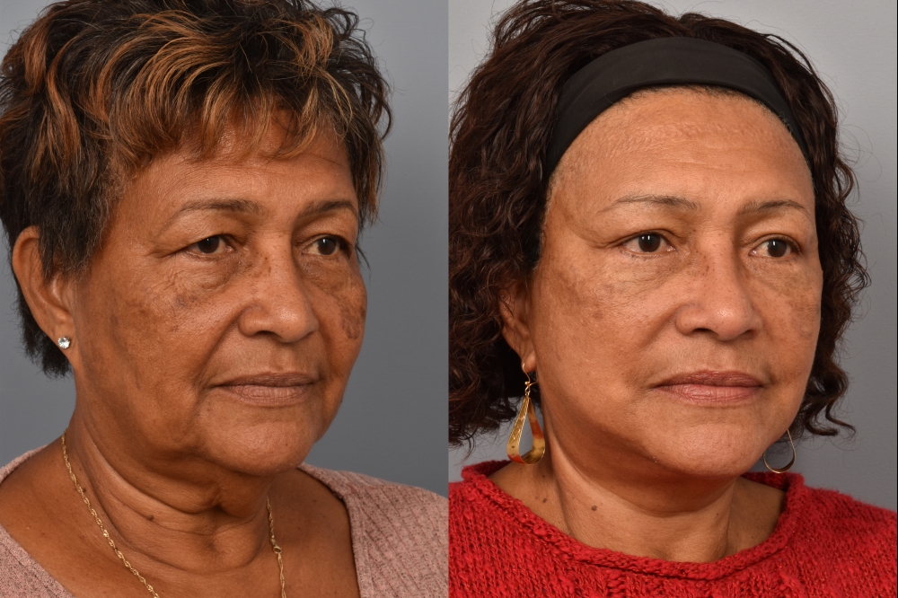 Side-by-side comparison of a female patient's right 3/4 view before and after a facelift performed by Dr. Pearlman. The left image shows visible signs of facial aging, including sagging skin and jowls. The right image, taken from the same angle post-surgery, reveals a more lifted, youthful jawline and smoother facial contours.