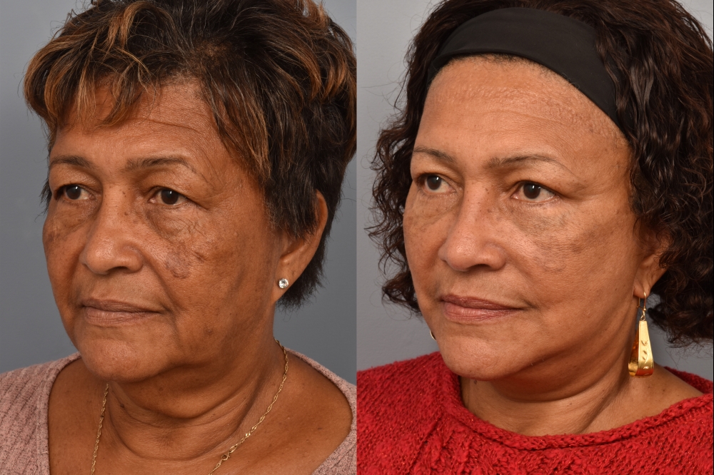 Side-by-side comparison of a female patient's left 3/4 view before and after a facelift performed by Dr. Pearlman. The left image shows visible signs of facial aging, including sagging skin and jowls. The right image, taken from the same angle post-surgery, reveals a more lifted, youthful jawline and smoother facial contours.