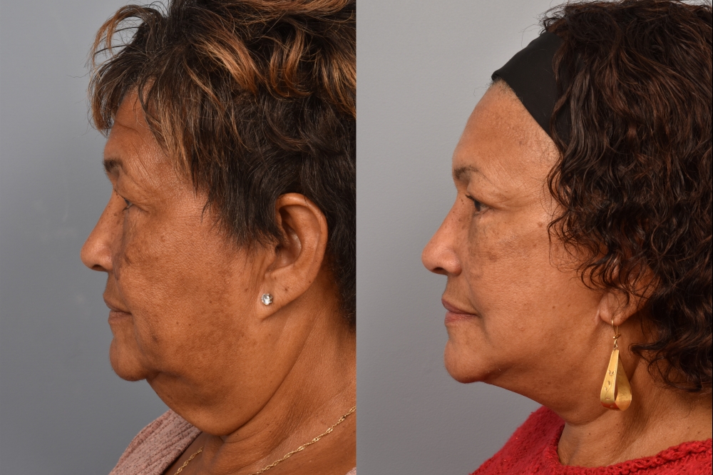 Side-by-side comparison of a female patient's left profile before and after a facelift performed by Dr. Pearlman. The left image shows visible signs of facial aging, including sagging skin and jowls. The right image, taken from the same angle post-surgery, reveals a more lifted, youthful jawline and smoother facial contours.