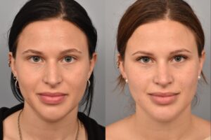 Left side of image is of a female patient's face showing her from a front on view before undergoing a rhinoplasty procedure with Dr. Pearlman. Right side of picture is the same female with the same view except it is after her rhinoplasty procedure. This is a side by side comparison of her rhinoplasty results before and after surgery