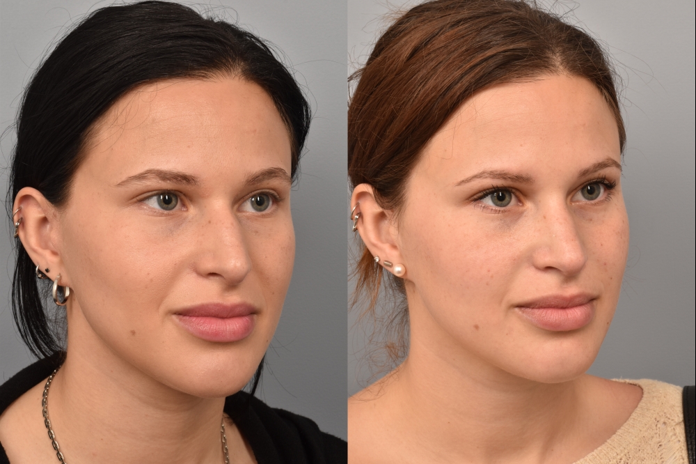 Left side of image is of a female patient's face showing her right 3/4 view before undergoing a rhinoplasty procedure with Dr. Pearlman. Right side of picture is the same female with the same view except it is after her rhinoplasty procedure. This is a side by side comparison of her rhinoplasty results before and after surgery