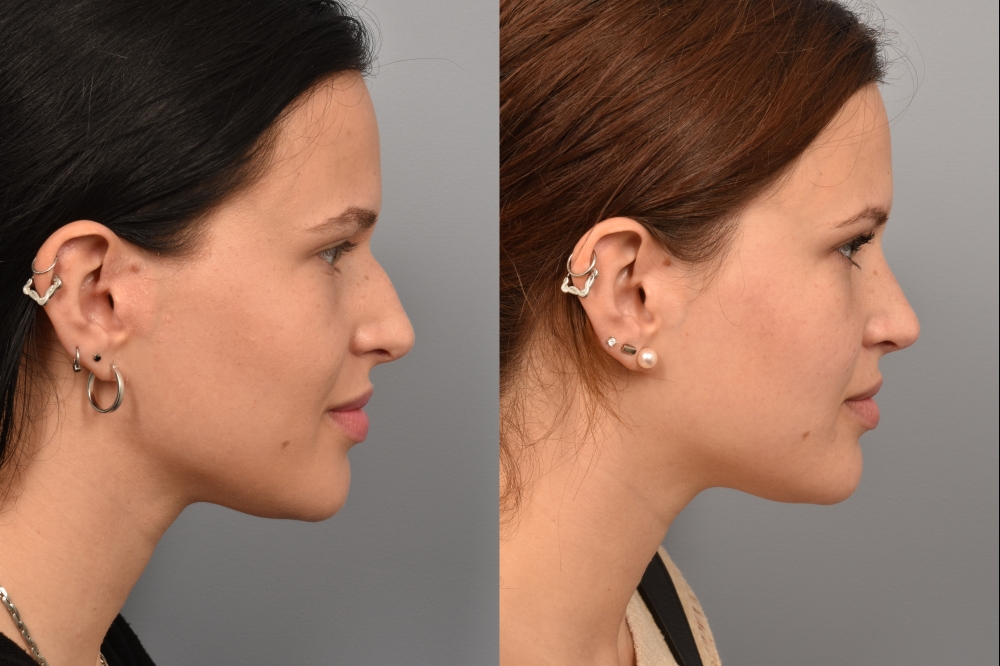 Left side of image is of a female patient's face showing her right profile before undergoing a rhinoplasty procedure with Dr. Pearlman. Right side of picture is the same female with the same view except it is after her rhinoplasty procedure. This is a side by side comparison of her rhinoplasty results before and after surgery
